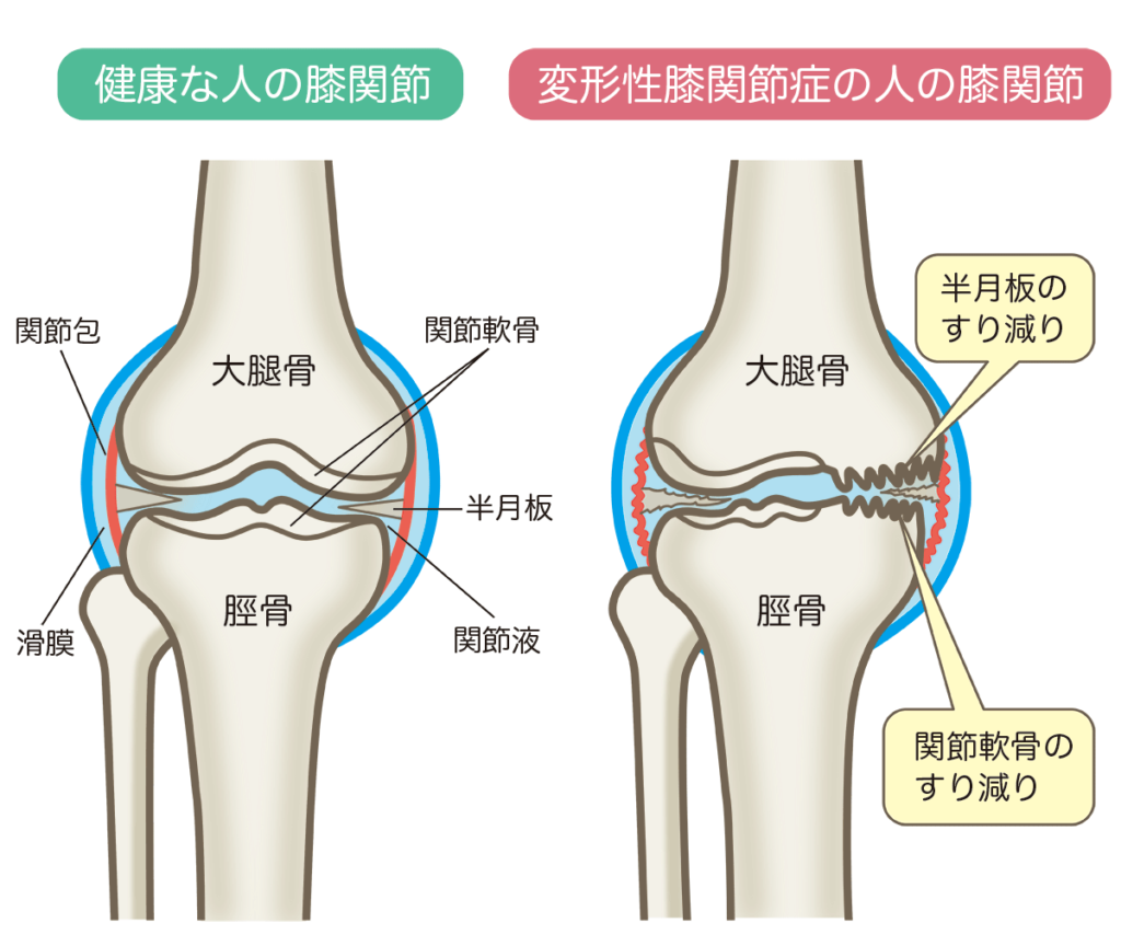 変形性膝関節症の人のひざ関節では、半月板のすり減り、関節軟骨のすり減りが見られます。