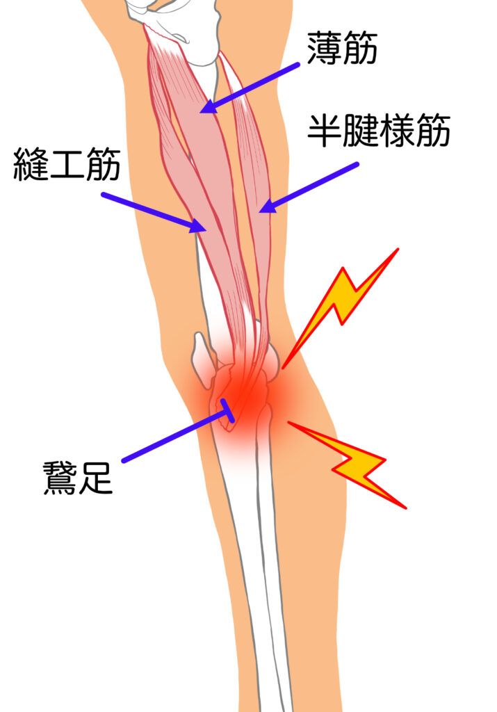膝の内側の痛みの原因は鵞足炎である場合があります。アイシングやストレッチを行なって治しましょう