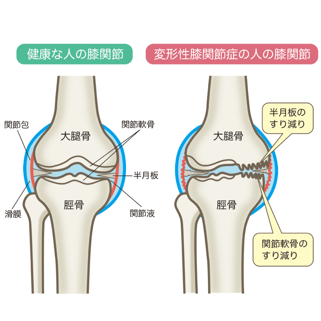 変形性膝関節症の膝では、半月板のすり減りや関節軟骨のすり減りがみられ、炎症を生じます。
