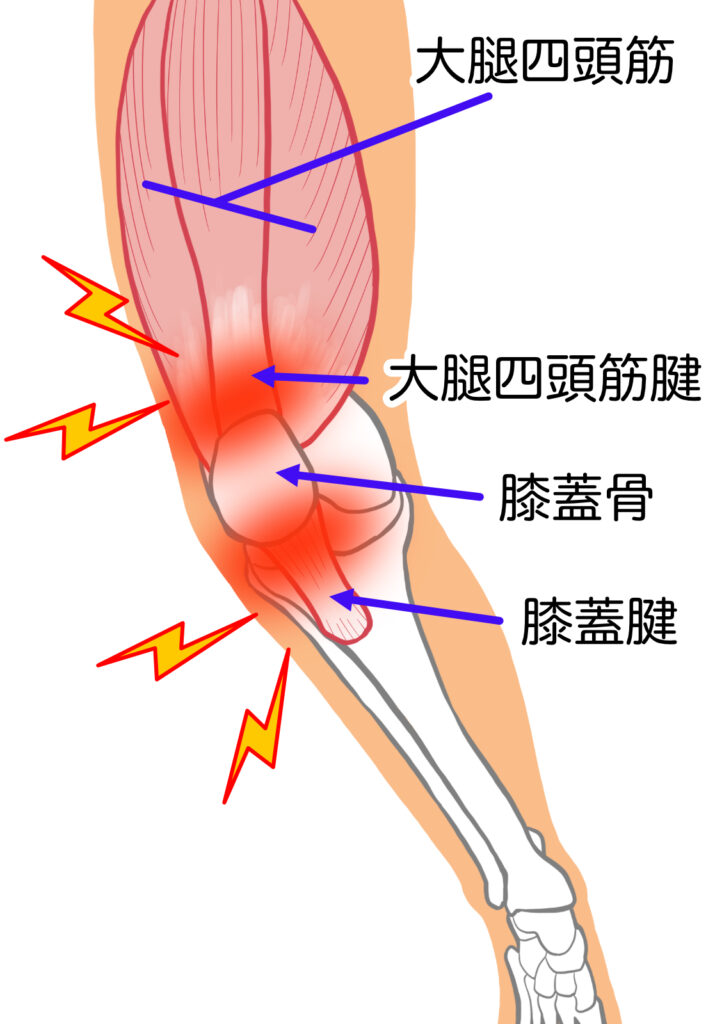 膝の上が痛い時、ジャンパー膝が疑われます。大腿四頭筋を膝蓋骨に結びつける腱の炎症を起こしている可能性があります。
