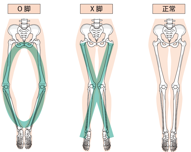 X脚は正常な形に比べて膝が内側に曲がっていることがわかる