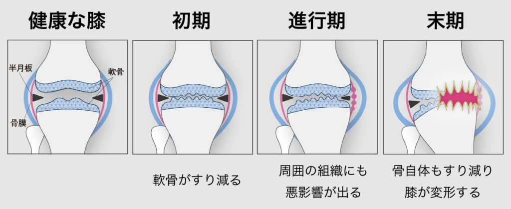 健康な膝では膝関節の軟骨が十分にあり、骨同士が直接当たることはありませんが、軟骨がすり減ることで、骨同士がぶつかり、痛みを感じます。
末期では骨が削れてしまい、外から見てもわかるくらいに膝が変形してしまします。