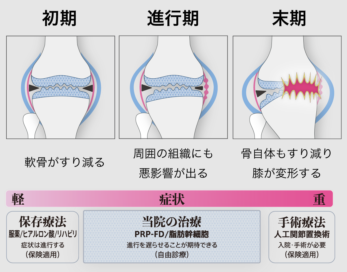 両側変形性膝関節症とともに生きる